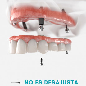 Prótesis Fija Vertical Catalán