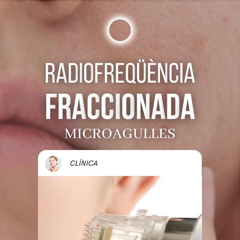 Radiofrecuencia Microagujas Vertical Catalán